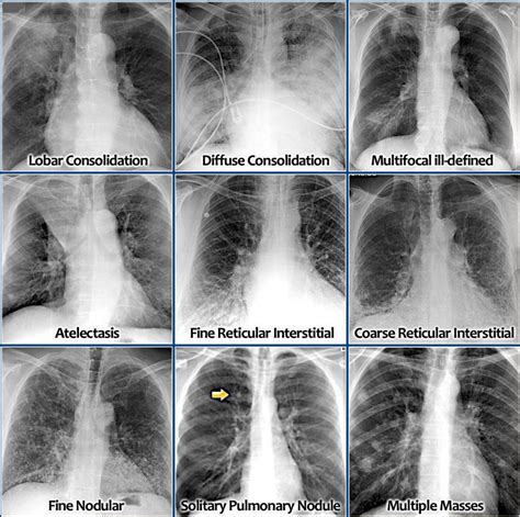 suspicious densities in both upper lobes|Multiple lung parenchymal abnormalities: Don’t panic, .